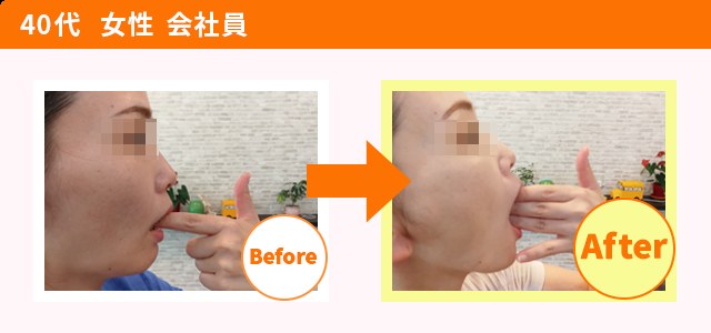 顎関節症 施術を受けた方の変化（一例・効果には個人差があります）