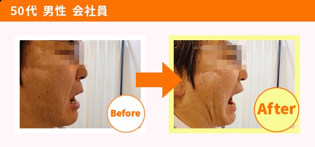 顎関節症 施術を受けた方の変化（一例・効果には個人差があります）