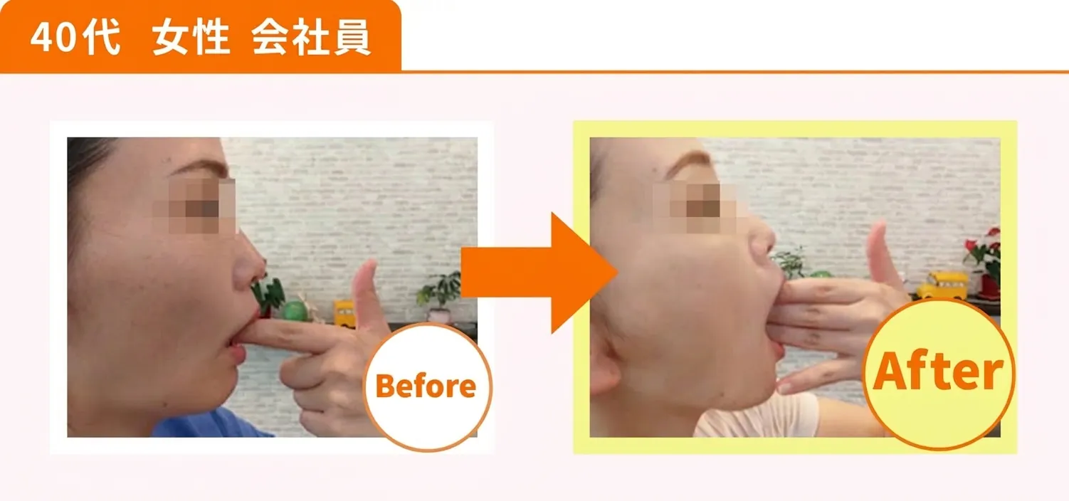 顎関節症ビフォーアフター5